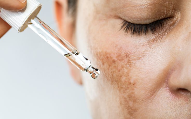 Demystifying Hyperpigmentation