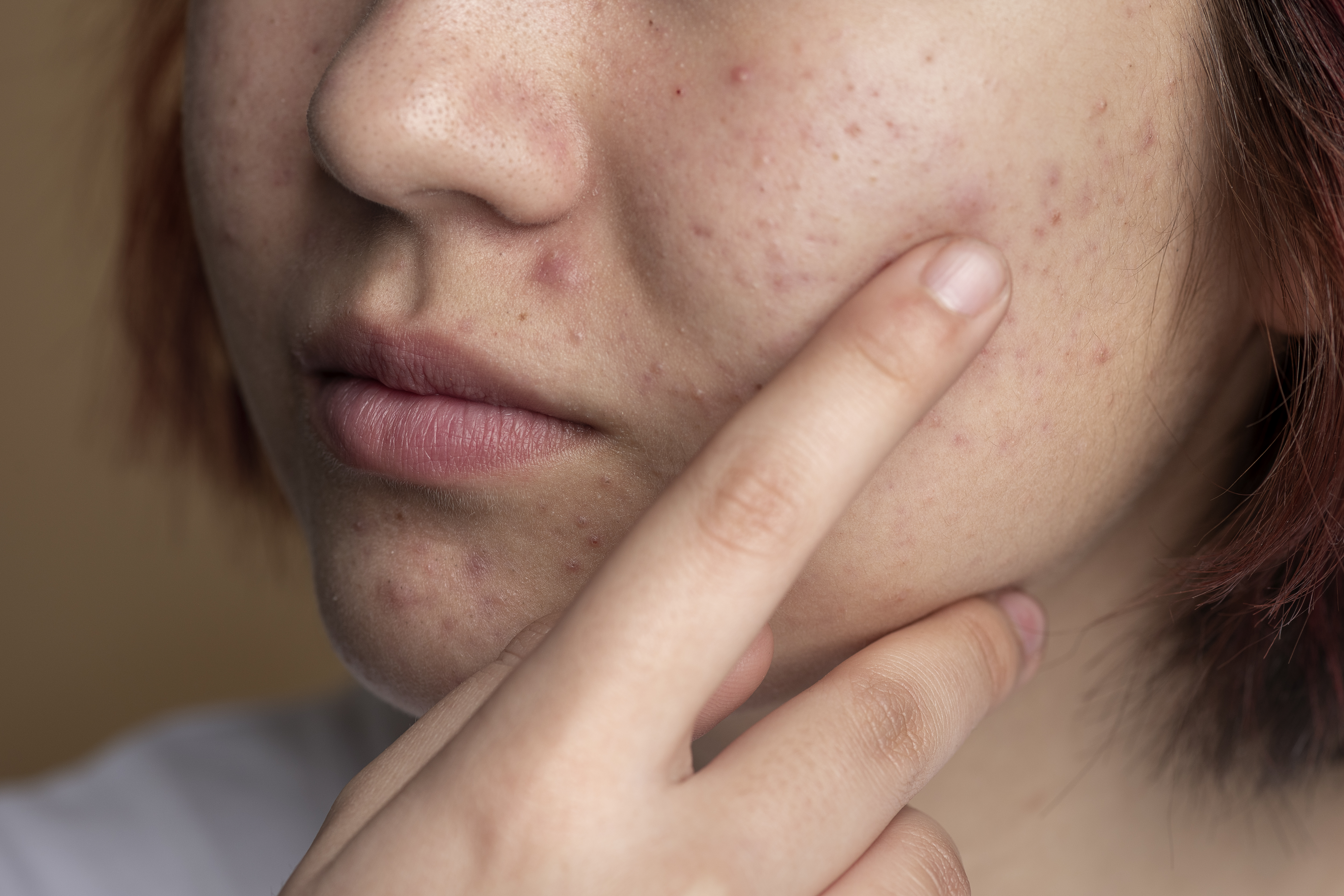 Why More & More People Are Experiencing Sensitive Skin