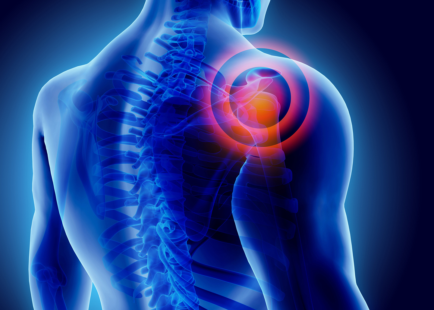 Frozen Shoulder